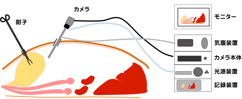 腹腔鏡補助での膀胱結石手術