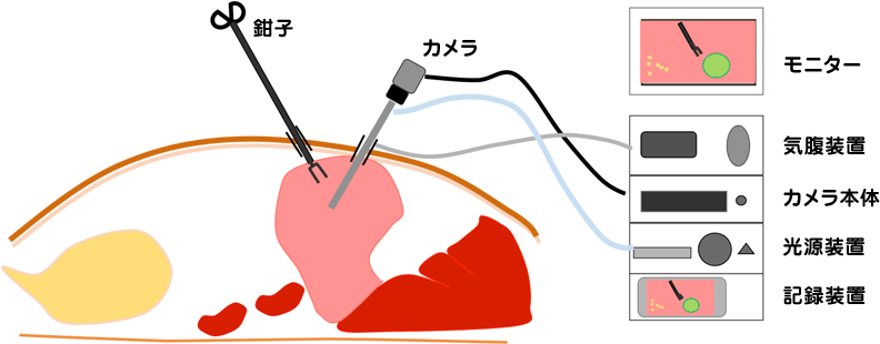 腹腔鏡補助での胃内異物手術