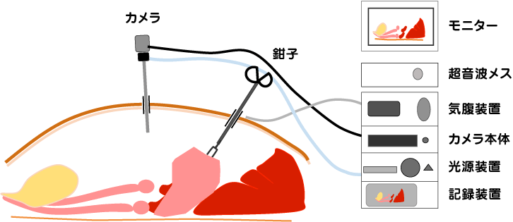 腹腔鏡補助での胃腹壁固定手術